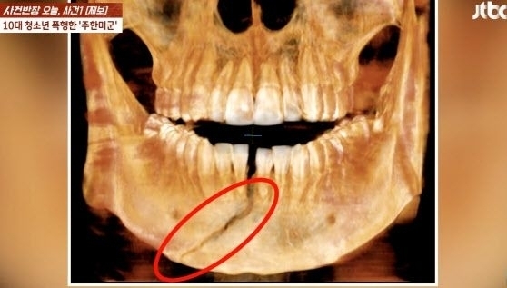 주한미군에게 폭행당신 10대 X레이 사진. /JTBC 