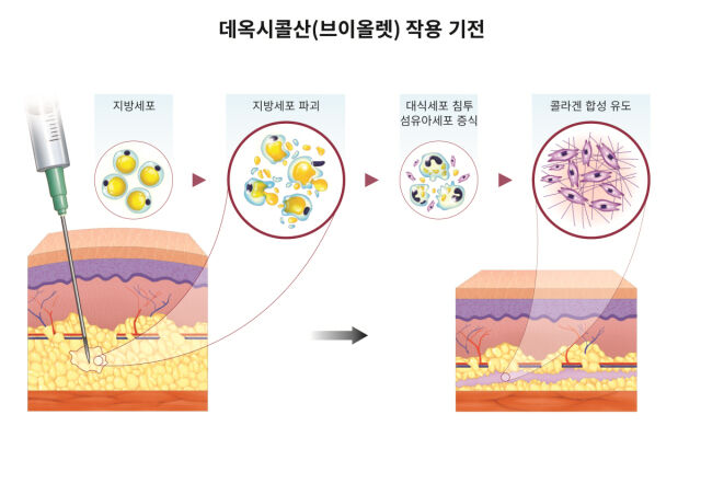 대웅제약은 지방파괴주사제 브이올렛(DCA)이 팔뚝 부위의 피하지방 감소에 유의미한 효과를 보였다는 연구 결과를 발표했다. /대웅제약